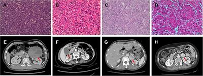 Chlorpromazine Efficiently Treats the Crisis of Pheochromocytoma: Four Case Reports and Literature Review